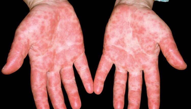 ما هو مرض أنفلونزا الطماطم وطرق العدوى والعلاج؟