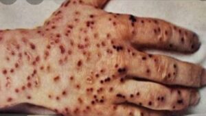 ما هو مرض الطاعون وأنواعه وطرق علاجه؟