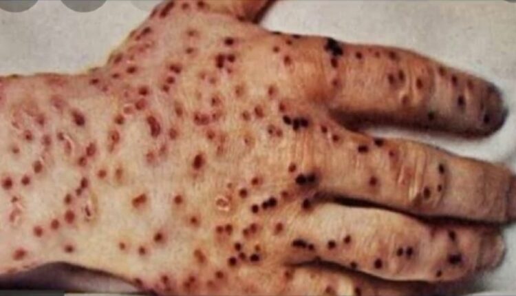 ما هو مرض الطاعون وأنواعه وطرق علاجه؟