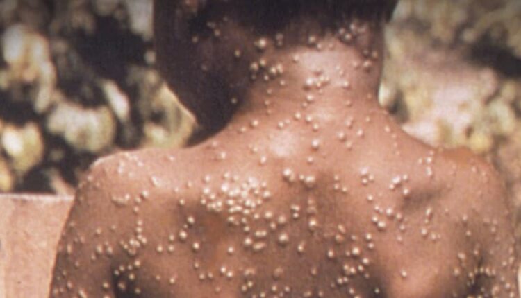 ما هو جدري القردة وهل حقا الوباء العالمي القادم؟